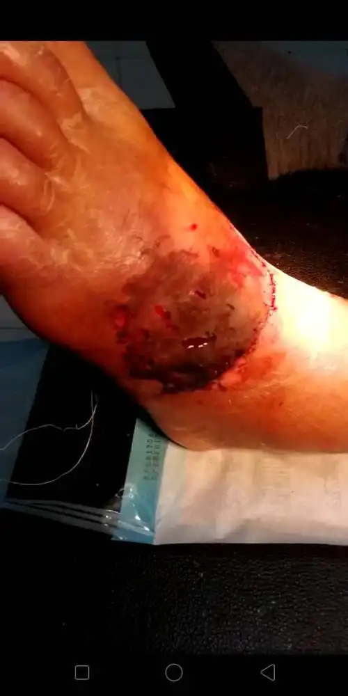 皮肤回植后表皮坏死出水是怎么回事