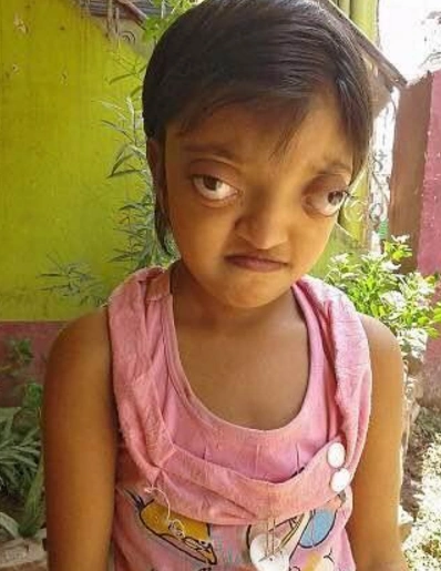 女孩出生眼睛就比较大,父母认为很好看,结果女孩长大后却愁坏了