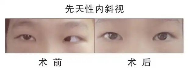 斜视治疗医院,合肥斜视治疗,斜视怎么矫正,成人斜视手术,合肥斜视手术