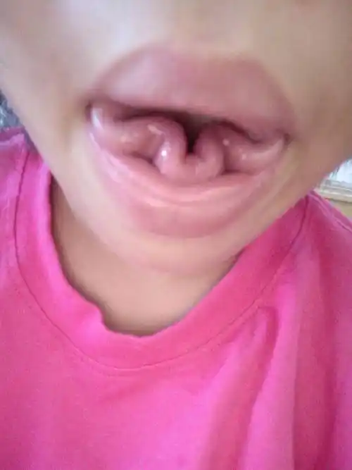 天生就会莲花舌的人有多少?概率是多少?