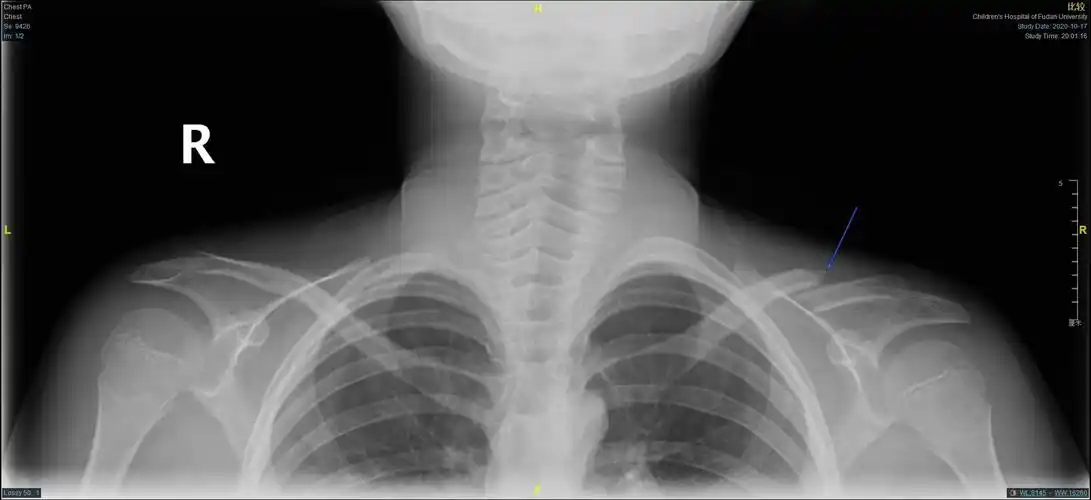 儿童锁骨骨折手术治疗(大于12岁)