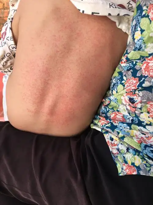 为什么宝宝后背还长的像痱子的东西