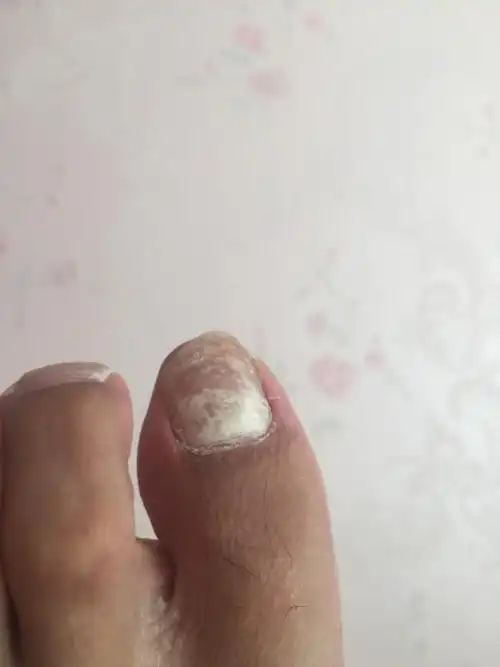 请问大夫,大母脚趾甲发白怎么回事,长期下不去,不疼不痒,是灰指甲吗?