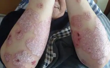 手臂牛皮癣银屑病发病原因初期图片及病症治疗