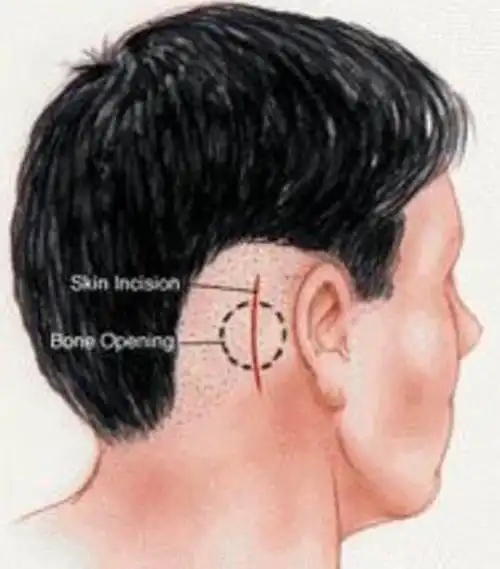 其它 显微血管减压术治疗三叉神经痛科普知识手术方式为耳后长约4厘米