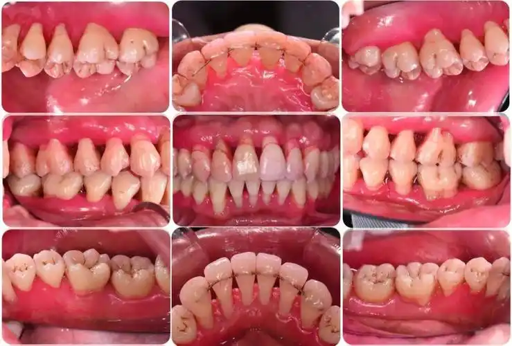 成人慢性牙周炎系统性治疗一例以菌斑控制为导向的牙周治疗2018病例展