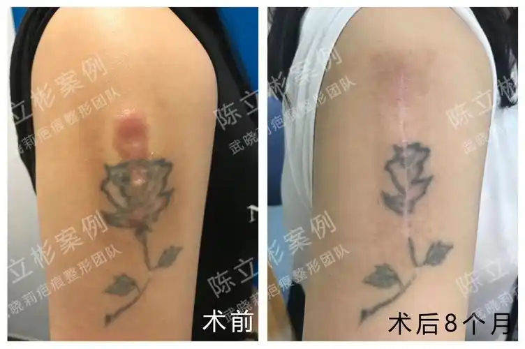 女性,34岁,去年9月局麻下行#上臂疤痕疙瘩#切除,#减张精细缝合#手术