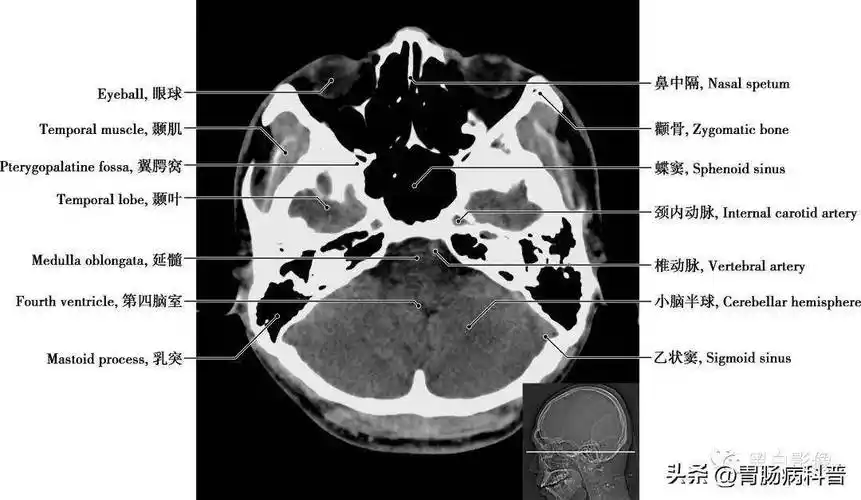 详细标注版——颅脑ct正常解剖图谱_中央_小脑_纤维
