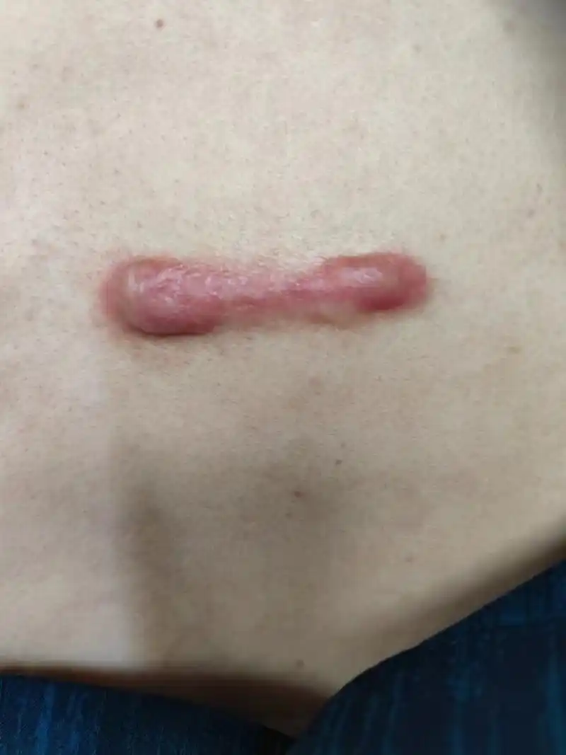 你为什么长疤痕疙瘩,你知道吗?