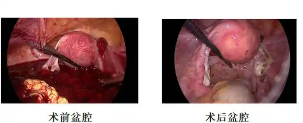 原因居然是这个,很多人都中招……|清宫术|妇科|手术|-健康界