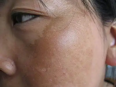 得了色斑怎么去除