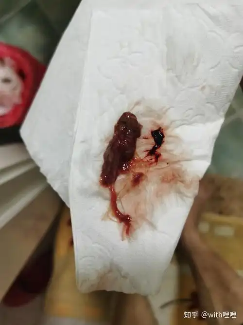 分享药流后有3㎝大残留物到28天无清宫排出的一些经历.