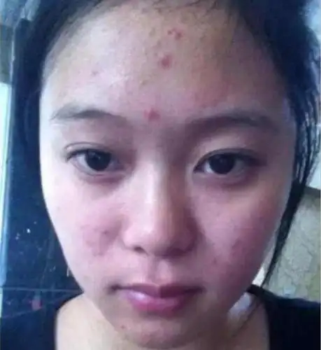 大学生青春痘困扰大学生长青春痘怎么办