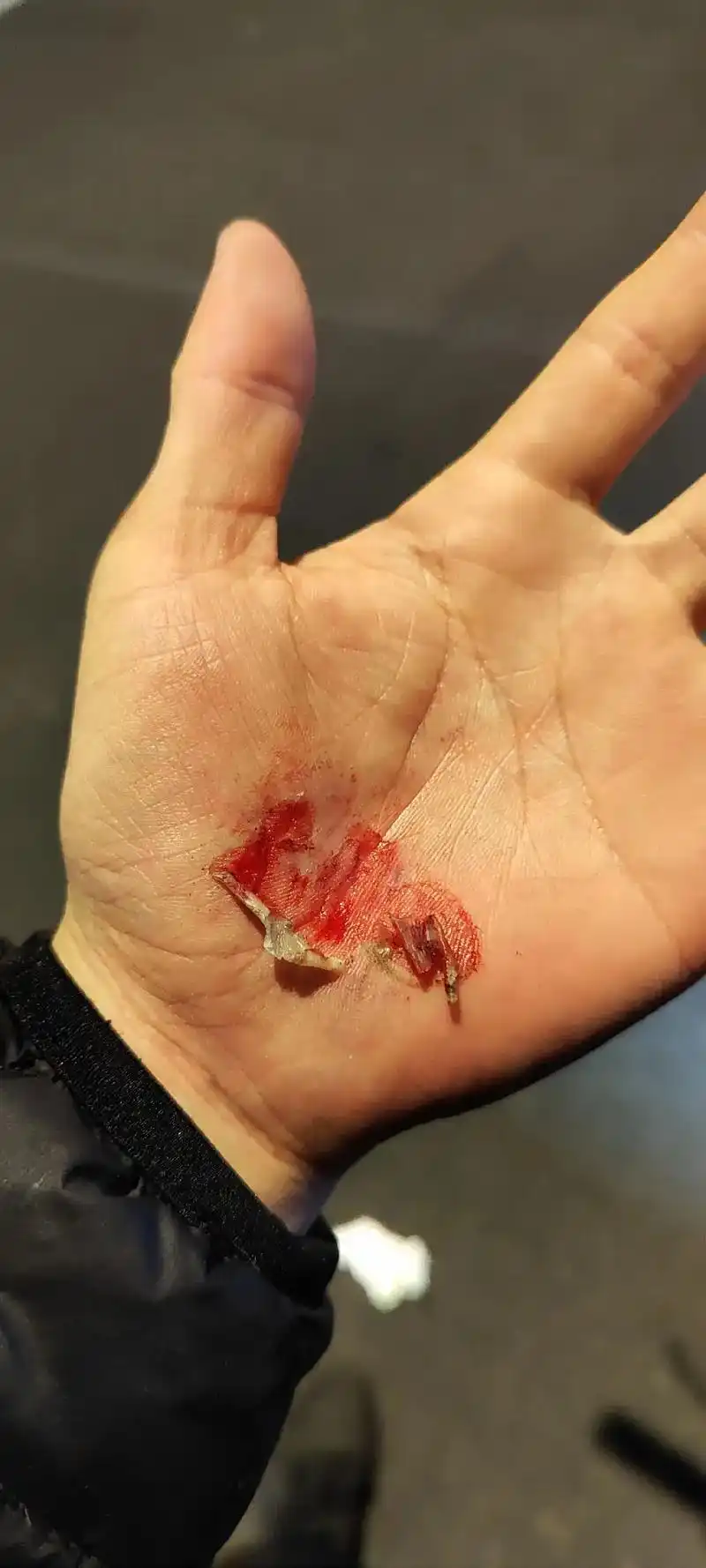 除了生死都是擦伤.从头到脚好像我身上完整的皮肤已经不多了  - 兑趑