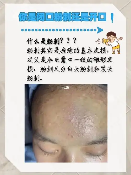 你长的是白头粉刺还是黑头粉刺?75