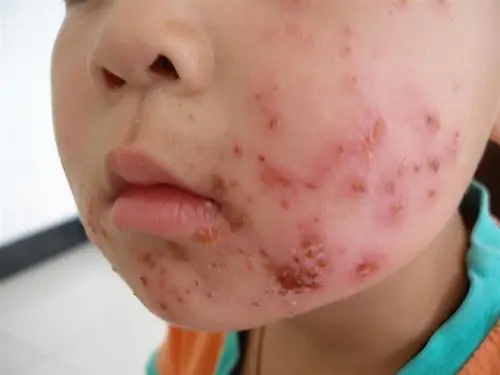 门诊病例17 脓疱疮