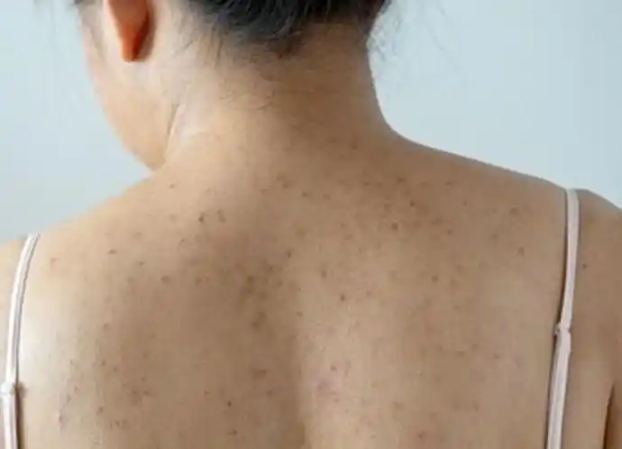 后背1亿螨虫的排泄物会这样侵蚀身体这3物是螨虫死对头