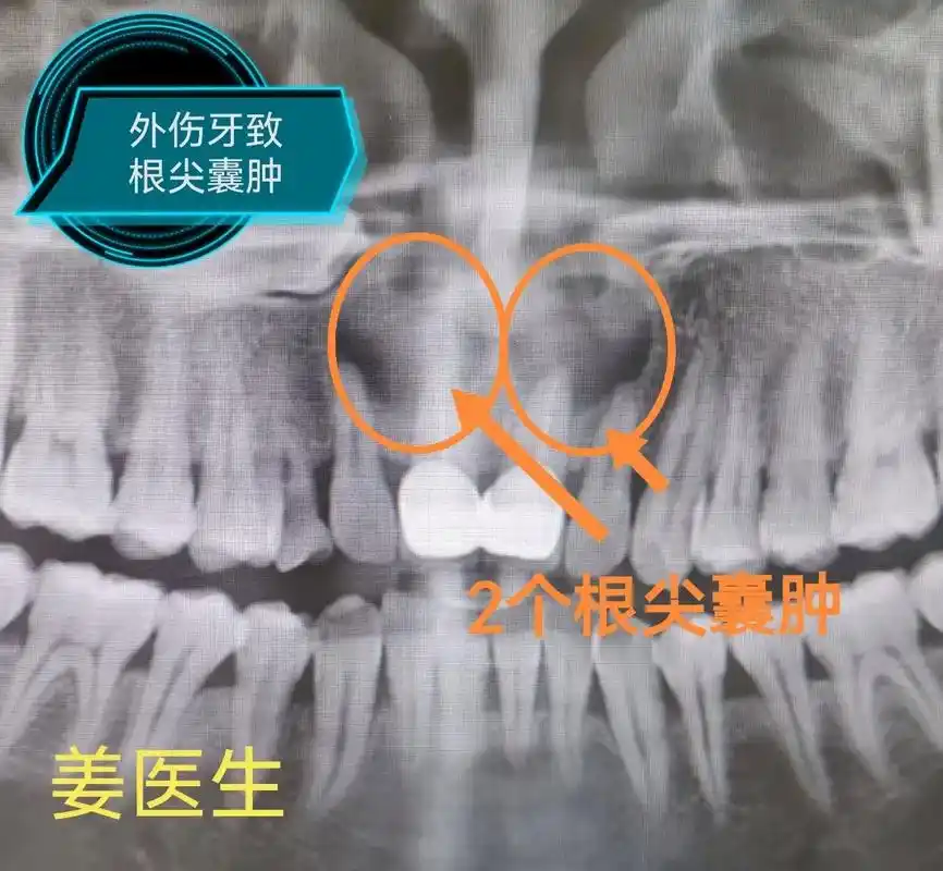 前牙外伤致根尖囊肿.总以为"牙齿"还年轻,却忽略了"囊肿"的 - 抖音