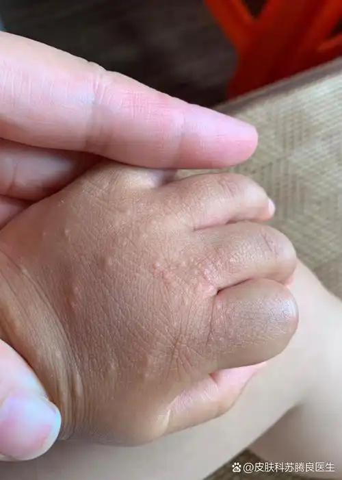 小孩手上起小米粒疙瘩是什么原因?