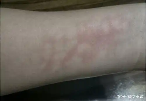 艾灸灸出白斑是怎么回事?艾灸有白斑能治愈吗?(单桂敏)