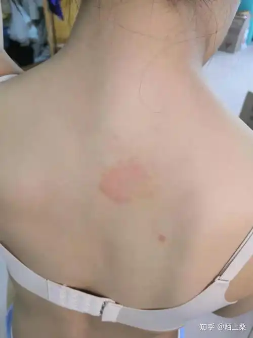 长了铜钱癣湿疹怎么办