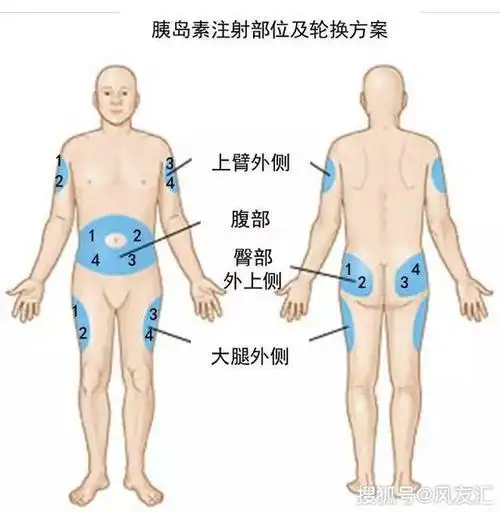 打胰岛素怎么打