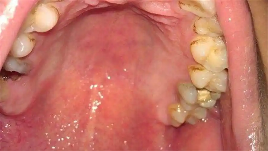 白色念珠菌感染口腔图