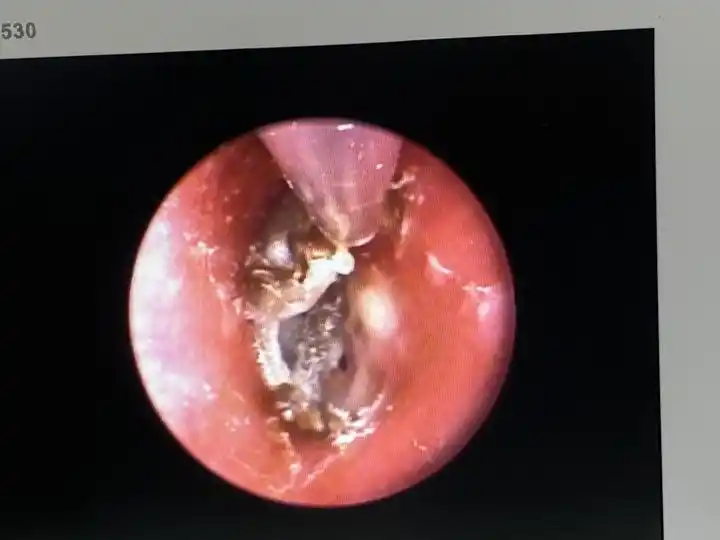 大伯耳朵里面"长毛"了!医生提醒:采耳动作可不能太凶猛