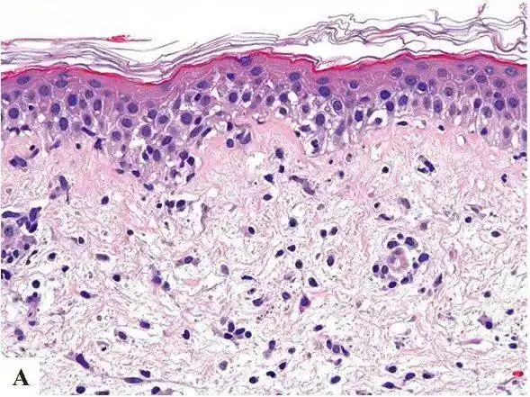 火眼金睛识别花样皮肤病
