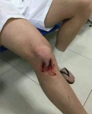 男生脚受伤流血的照片 - 搜狗图片搜索