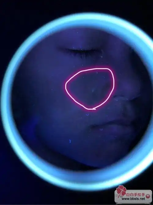 刚买了个伍德灯大家看看是不是白白?