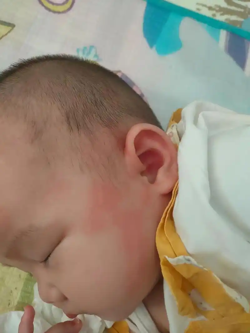问宝妈有没有家里小宝宝皮肤一抓就这样身上手上也是去看医生喝了过敏