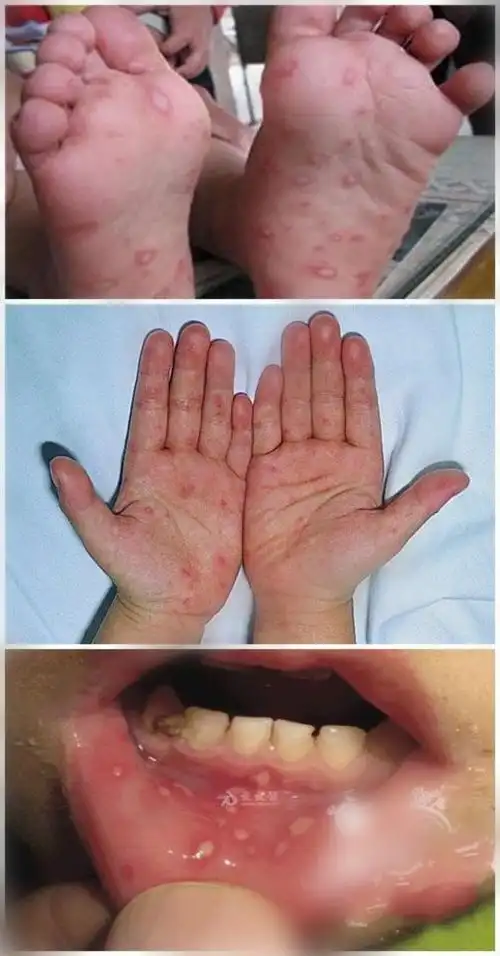 爆发手足口病,如何防止宝宝中招?