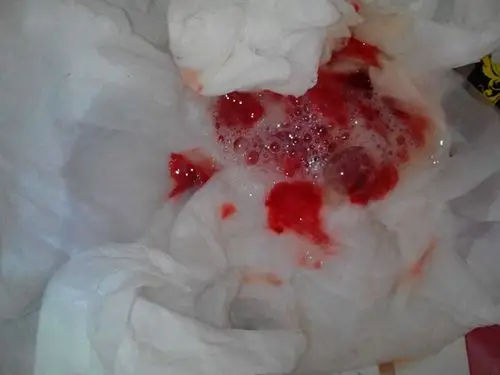 吐血图片 (25)_有来医生