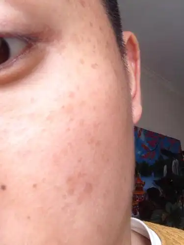 脸上的扁平疣怎么去除,很多年了,醋泡鸡蛋管用吗?