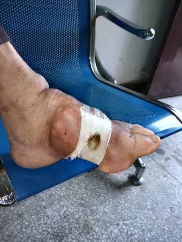 罕见的痛风结石分享一下