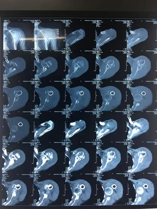 永城市中心医院骨二科成功完成一例人工肩关节置换手术