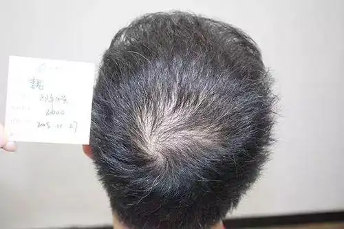 青年脱发两次植发2300 2000单位变小鲜肉