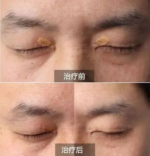 睑黄疣怎么治能去根