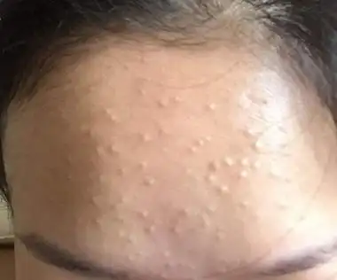 说说脸上的"脂肪粒"