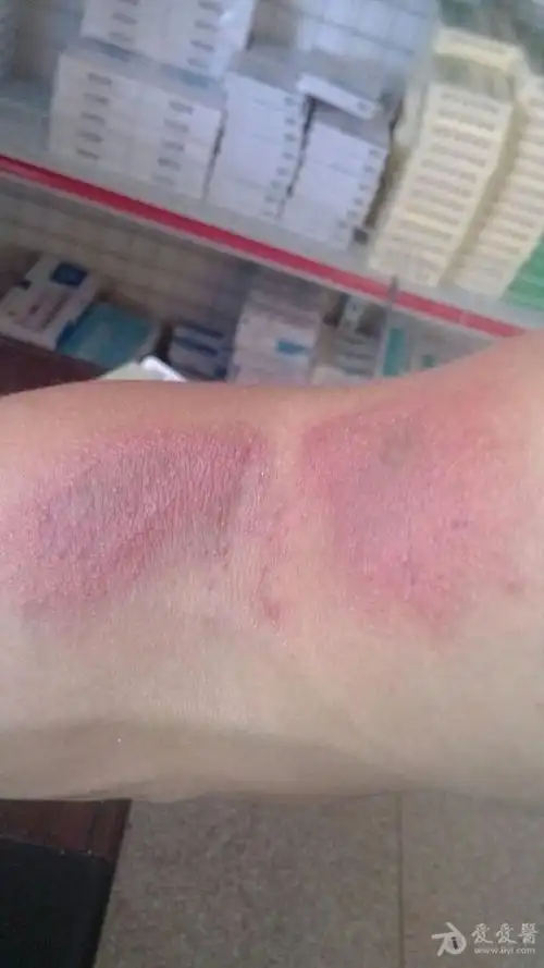 被不知名虫子咬了已有7天