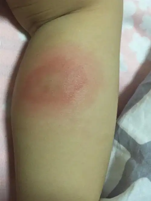 宝宝被蚊子咬后的皮肤:宝宝被蚊子咬了皮肤硬红肿怎么办?