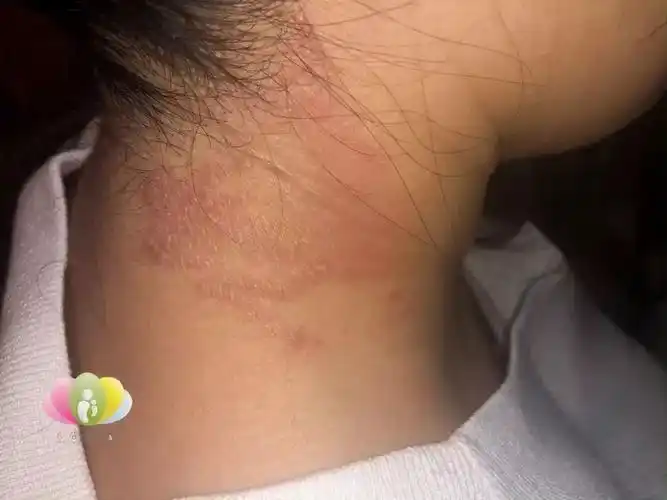 她先是右侧脖子红红地出了一大片红疹,去检查,说是过敏导致的特应性