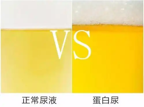 尿多,尿频是正常排便?尿尿出现这种颜色,当心肾病!