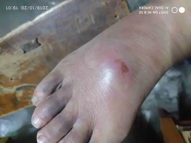 脚咂肿有瘀血己经八天了在床上不痛一下地时就痛