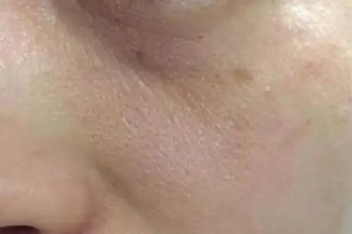 1,老化型毛孔粗大