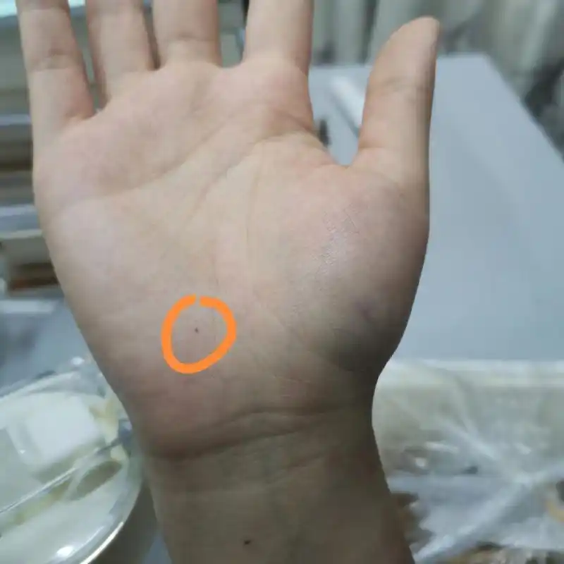 手心突然长了一颗小小的痣  最近突然发现手心长了颗痣,以为是脏东西