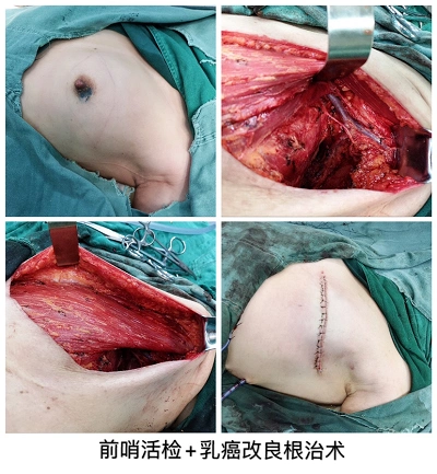 以往对男性乳腺发育症,女性乳腺良恶性疾病的手术治疗,往往采用乳晕外
