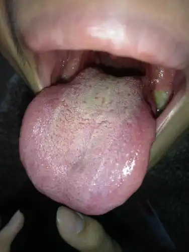 请问这个是毛状白斑吗,牙齿磨一下舌头表面,舌头表面的白白的就跟毛一