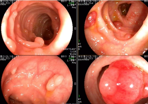 关于肠镜检查你想知道的都在这里